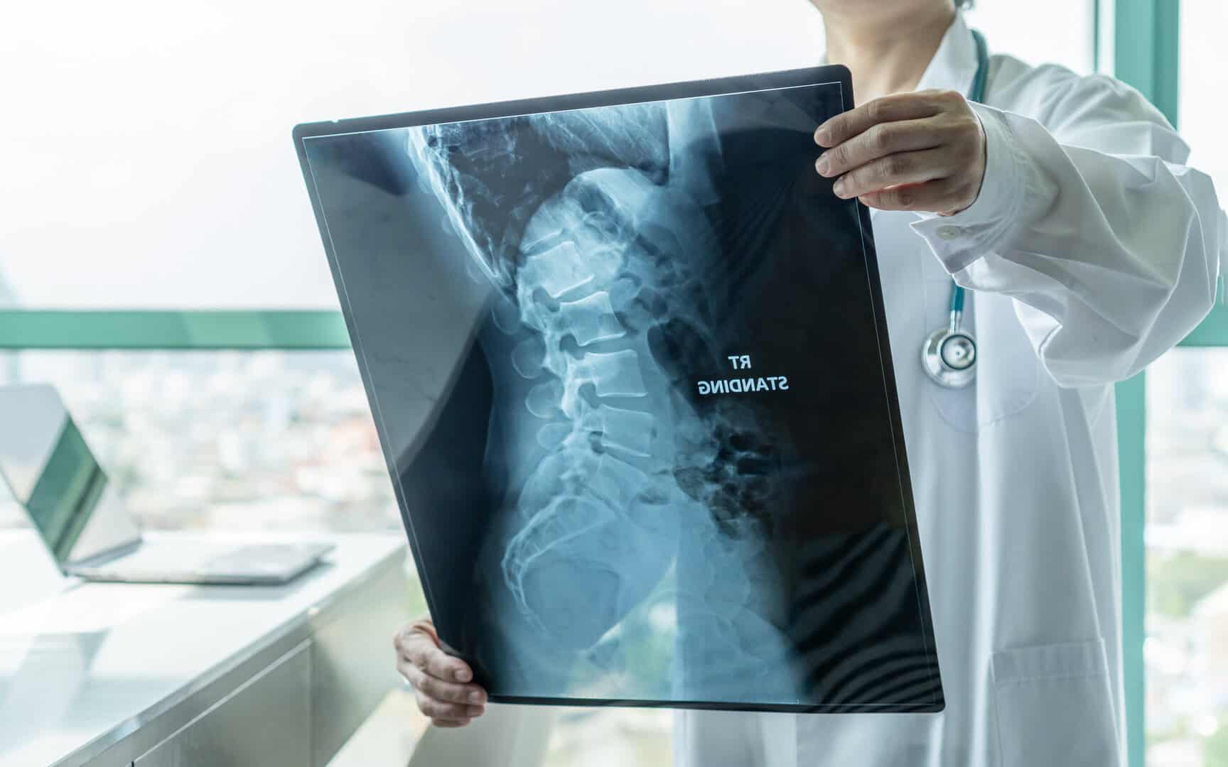 cancro ossa nuove cure